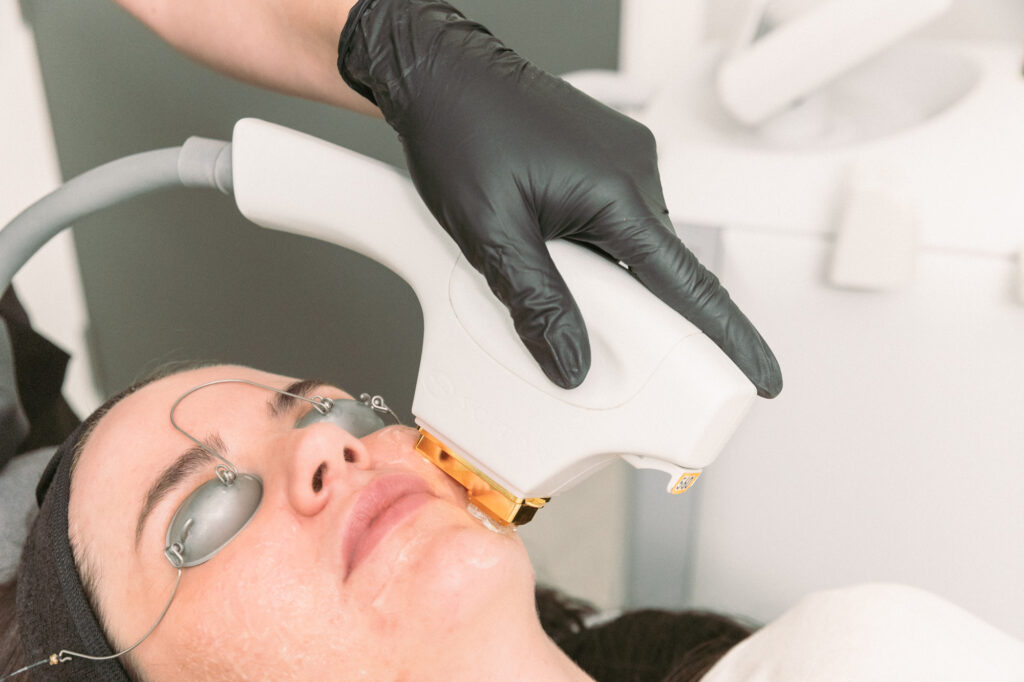 Our provider uses the BBL hand piece on the patient's skin for facial rejuvenation in Burlington. The female patient lies on the treatment table, with cooling gel on her face, and wears eye protection.