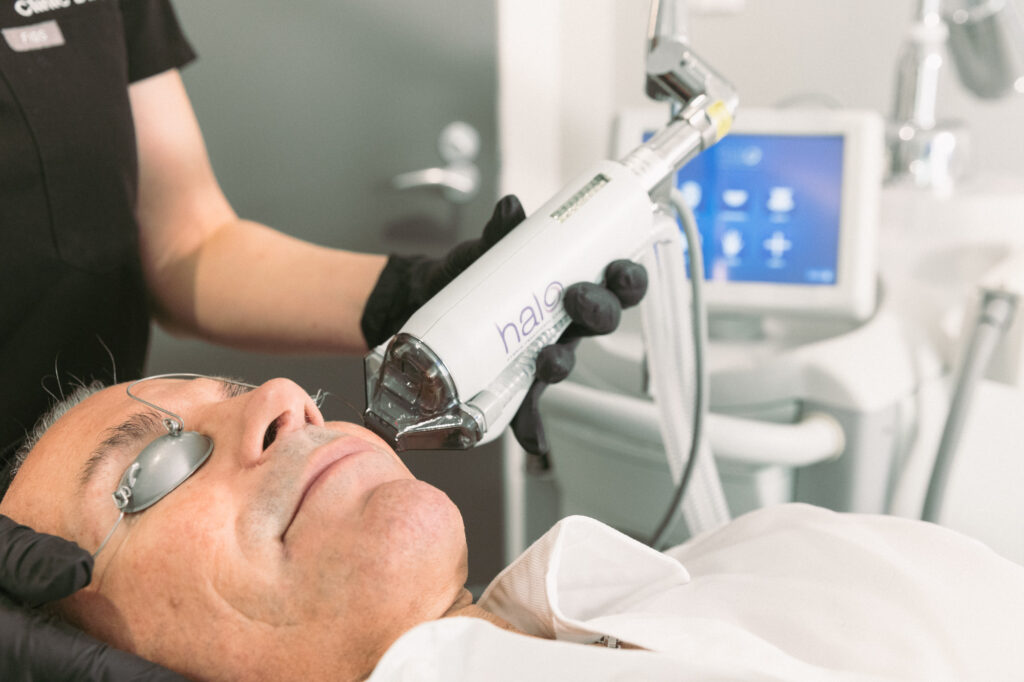 A male patient receives facial rejuvenation in Burlington with the Halo laser. The provider uses the laser on his cheeks to reduce wrinkles and signs of aging. 