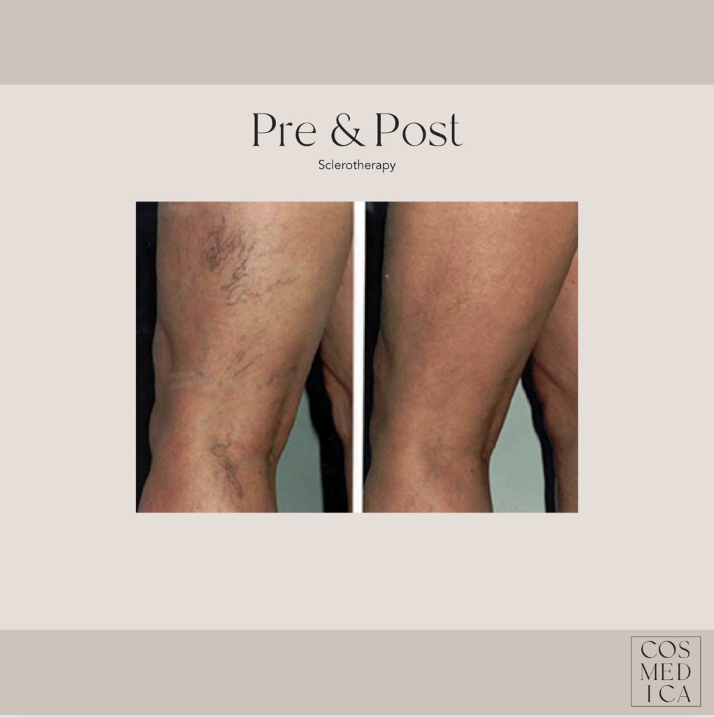 A before and after set of 2 pictures. One shows a patient's legs before having varicose vein treatment in Burlington, clearly exhibiting spider veins on the back of the thigh. The after-image shows how clear the patient's skin is now post-treatment.