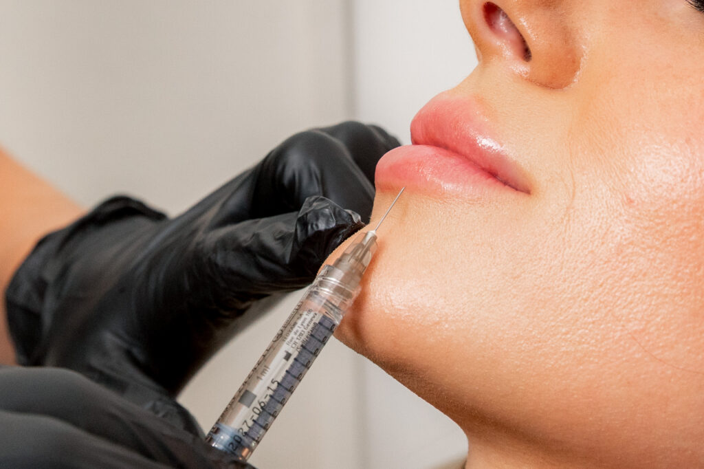 A close-up of a patient receiving lip filler near Hamilton.